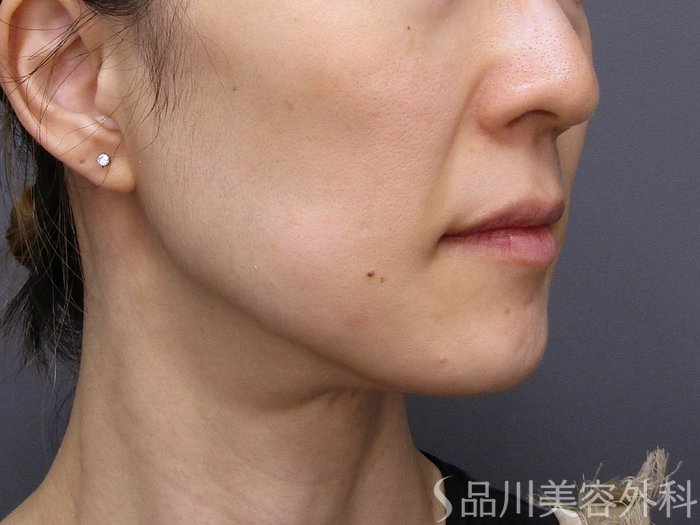 症例NO.75128のBEFORE写真