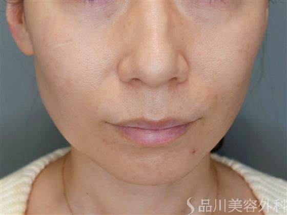 症例NO.51123のBEFORE写真