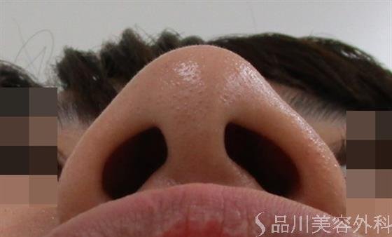 症例NO.43592のBEFORE写真