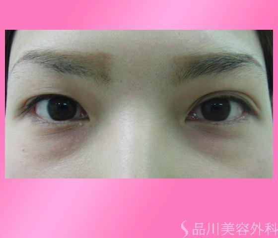 症例NO.4089のBEFORE写真