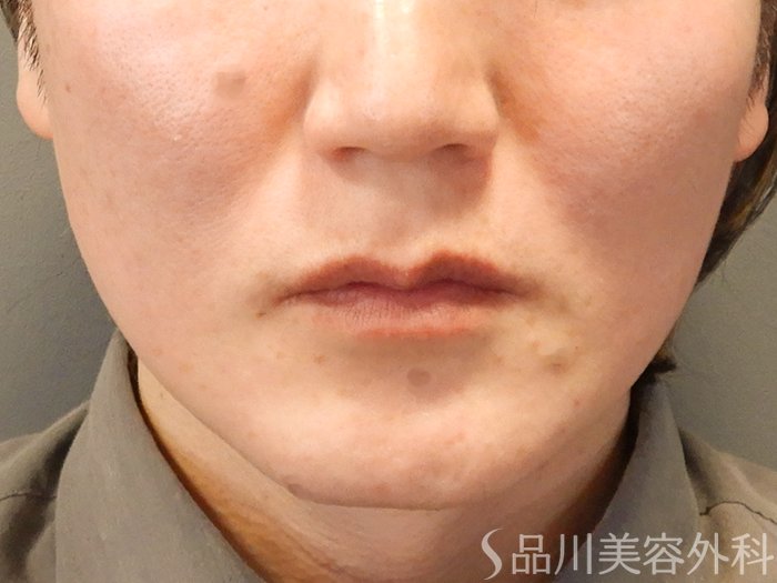 症例NO.70204のBEFORE写真