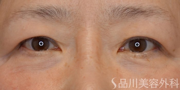 症例NO.73818のBEFORE写真