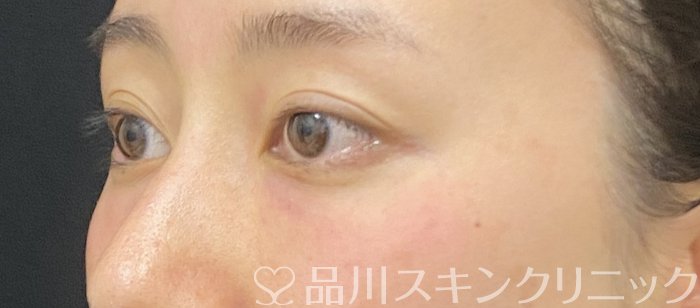 症例NO.74931のAFTER写真