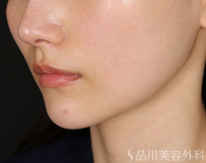 症例NO.73924のBEFORE写真