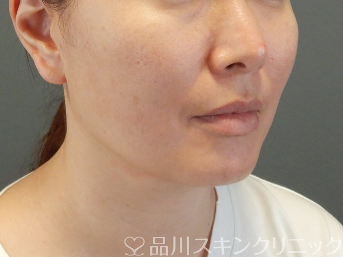 症例NO.65379のBEFORE写真