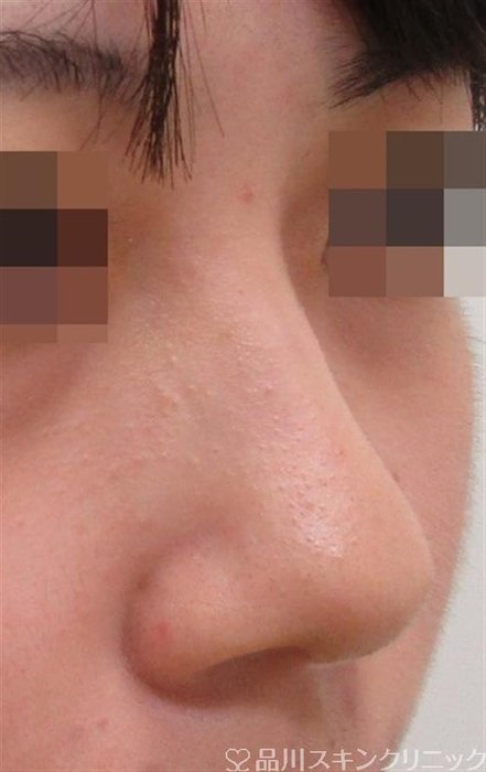 症例NO.30559のBEFORE写真