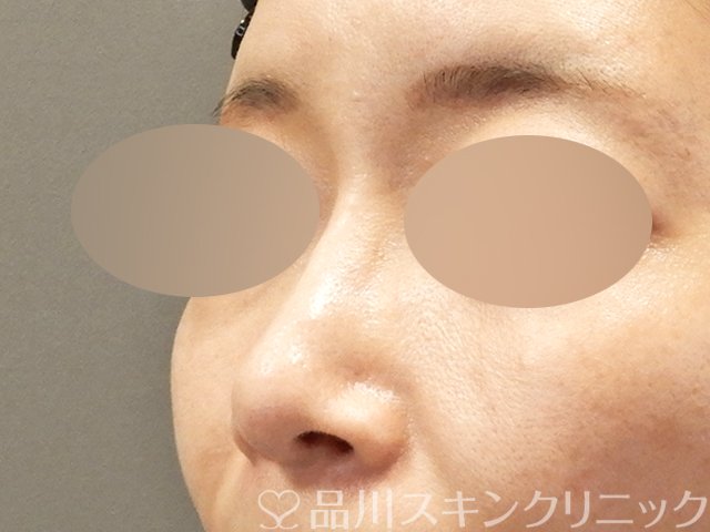 症例NO.68927のAFTER写真