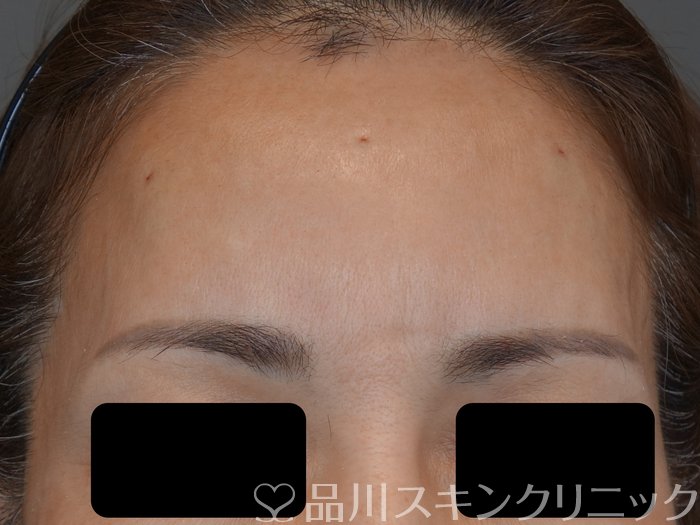 症例NO.73466のAFTER写真