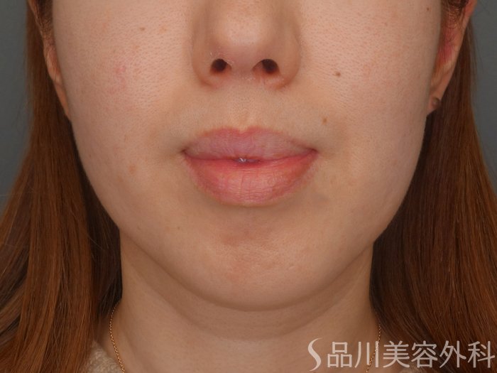 症例NO.72251のBEFORE写真