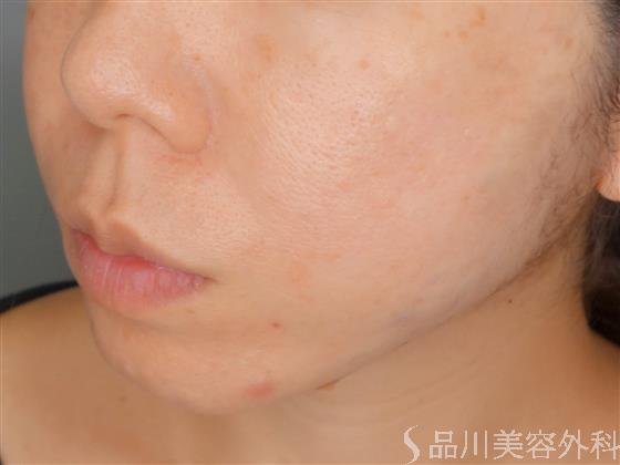 症例NO.51718のAFTER写真