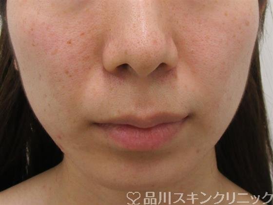 症例NO.36920のBEFORE写真