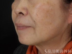 症例NO.73530のBEFORE写真