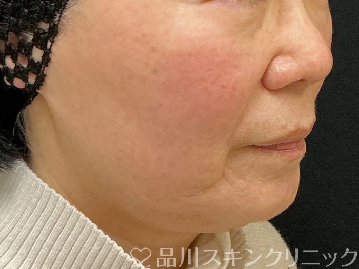 症例NO.73538のBEFORE写真