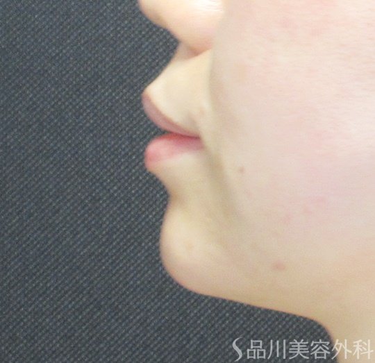 症例NO.70048のAFTER写真