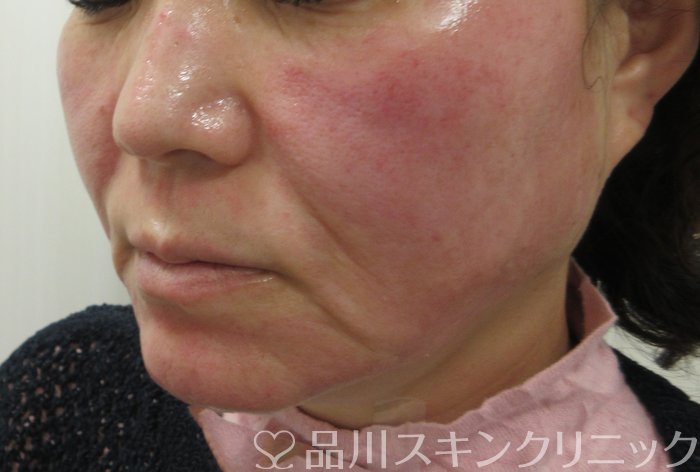 症例NO.72828のBEFORE写真