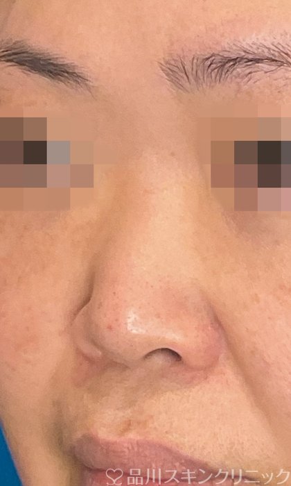 症例NO.75091のBEFORE写真