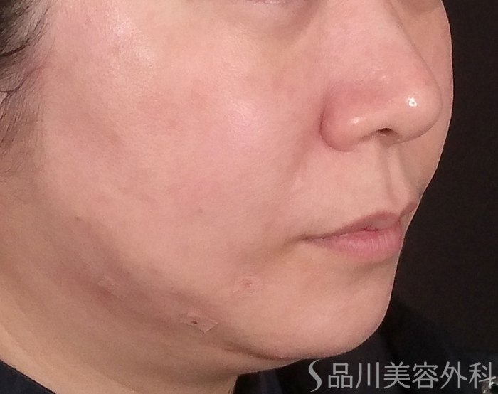 症例NO.68961のAFTER写真