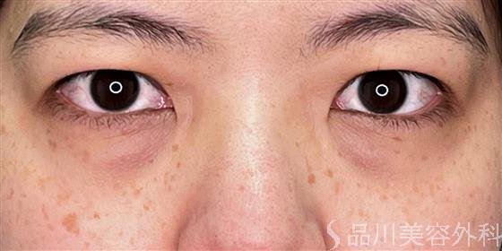 症例NO.54789のBEFORE写真