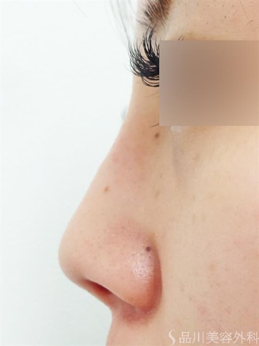 症例NO.43849のAFTER写真