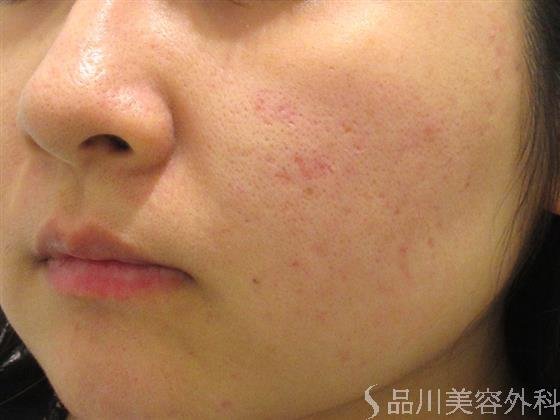 症例NO.23264のAFTER写真