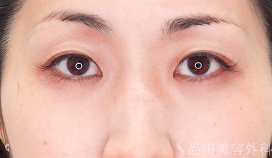 症例NO.60627のAFTER写真