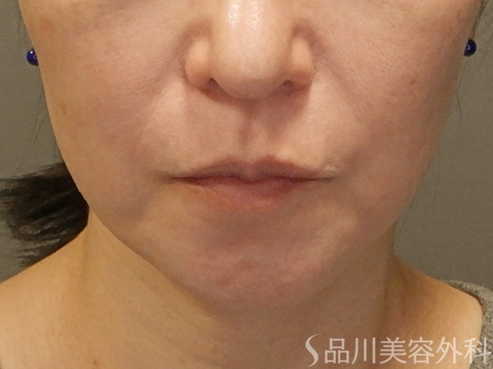 症例NO.70357のBEFORE写真