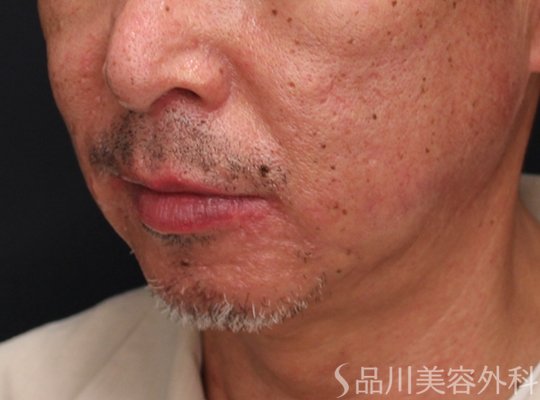 症例NO.72129のAFTER写真