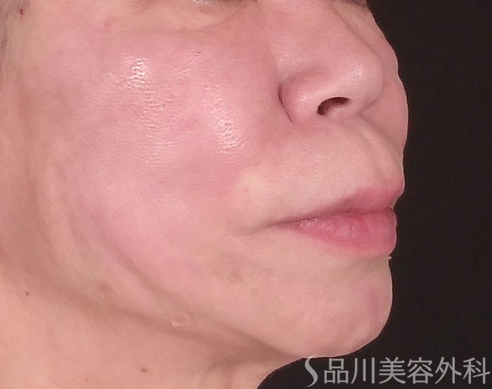 症例NO.70354のAFTER写真