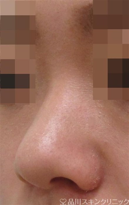 症例NO.42154のBEFORE写真