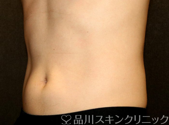 症例NO.74572のAFTER写真