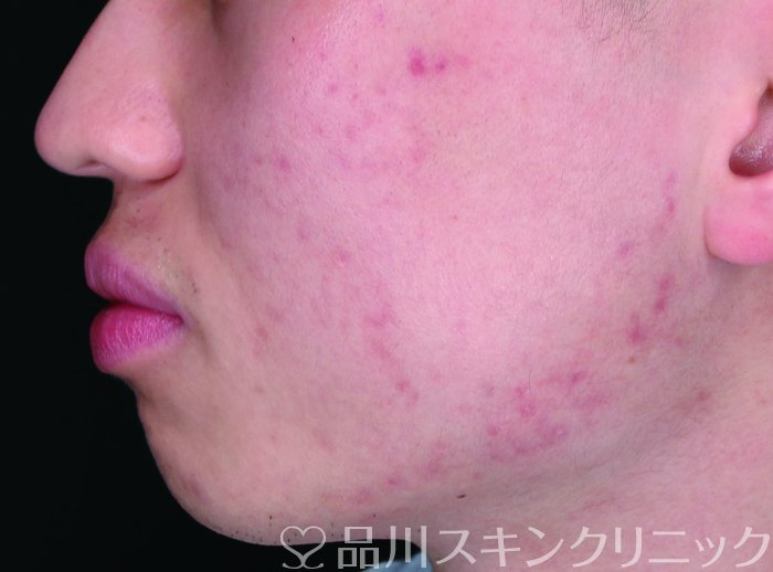 症例NO.72291のAFTER写真