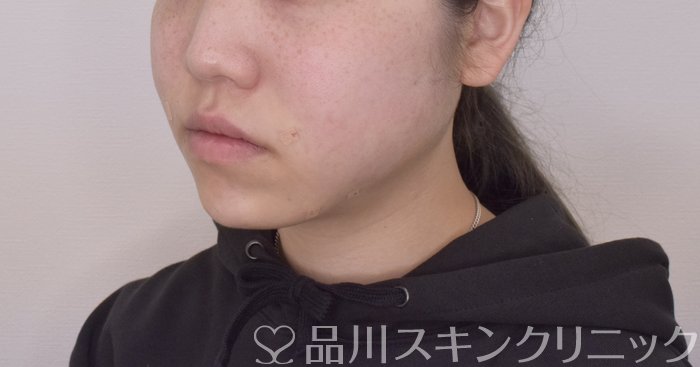 症例NO.64450のAFTER写真