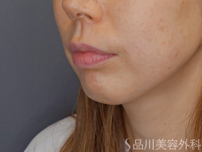 症例NO.70631のBEFORE写真