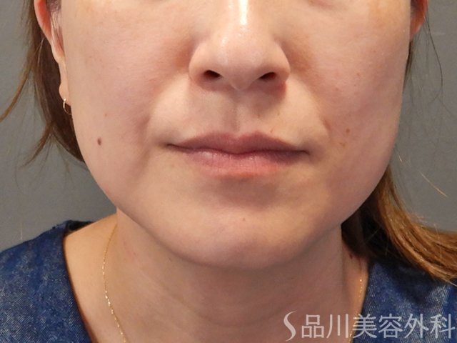 症例NO.74952のBEFORE写真