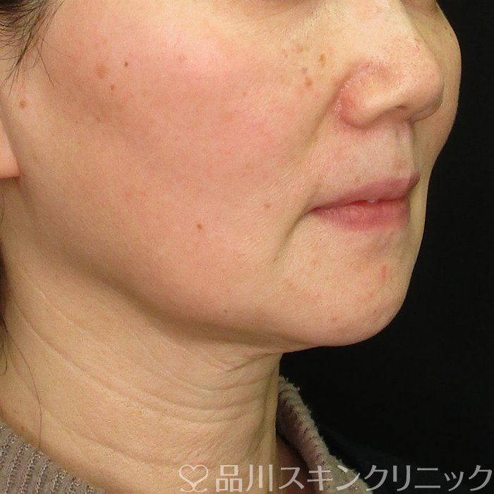症例NO.69702のBEFORE写真