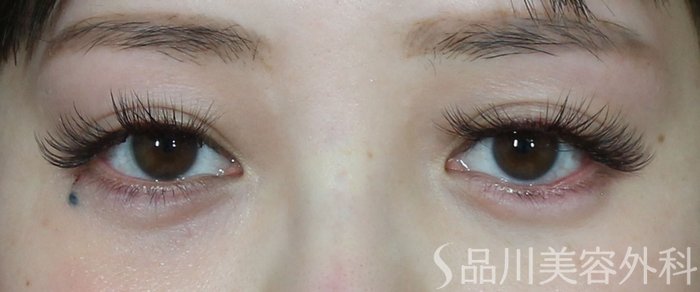 症例NO.73423のAFTER写真