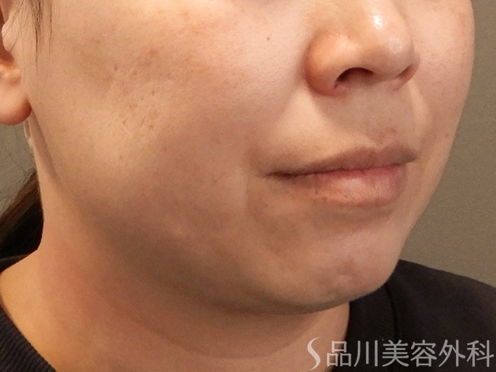 症例NO.69356のBEFORE写真