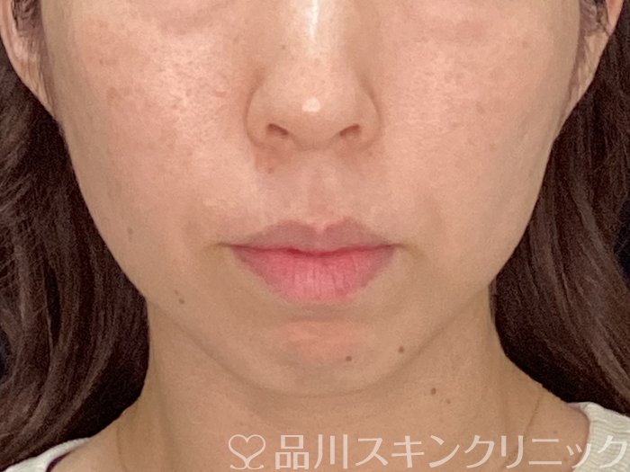 症例NO.72605のBEFORE写真