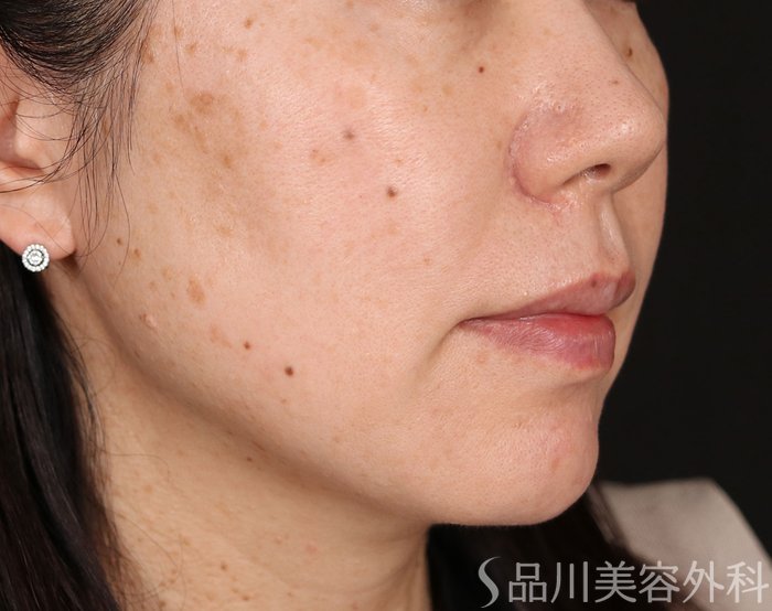 症例NO.72124のAFTER写真