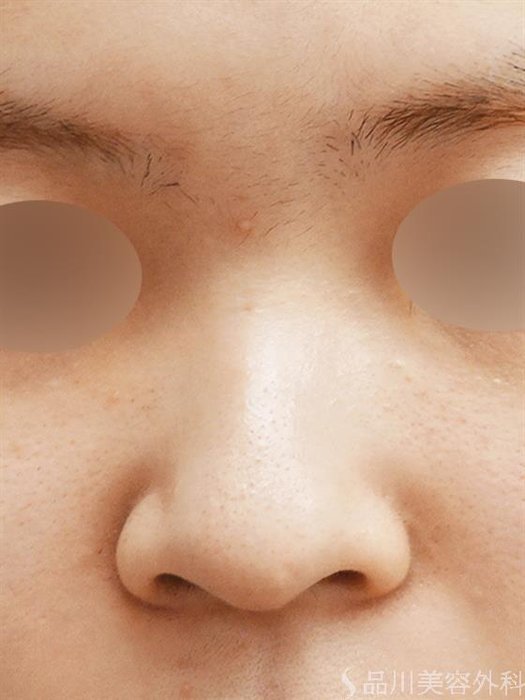 症例NO.49146のBEFORE写真