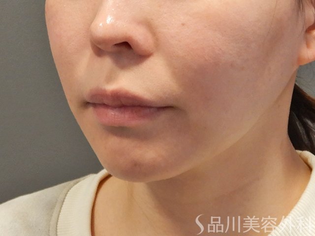 症例NO.73780のBEFORE写真