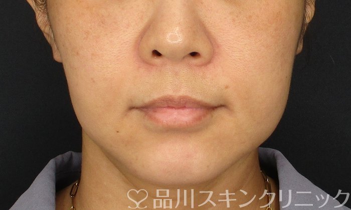 症例NO.73641のBEFORE写真