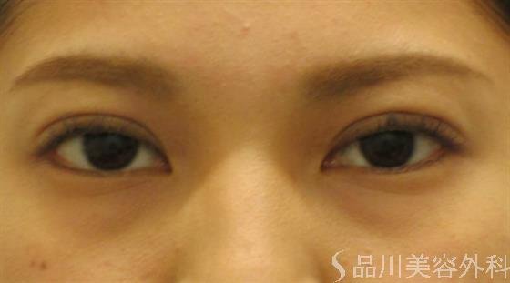 症例NO.47471のAFTER写真