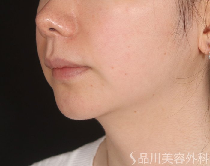 症例NO.73736のBEFORE写真