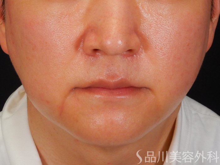 症例NO.67592のBEFORE写真