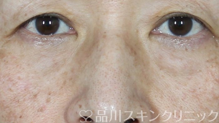 症例NO.71730のBEFORE写真