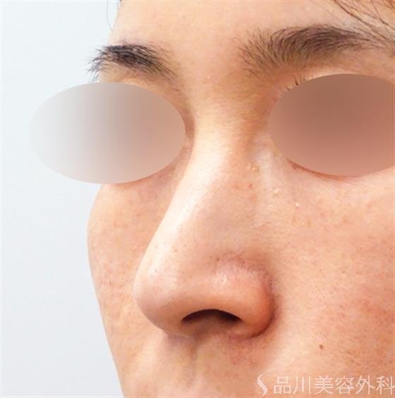 症例NO.51089のBEFORE写真