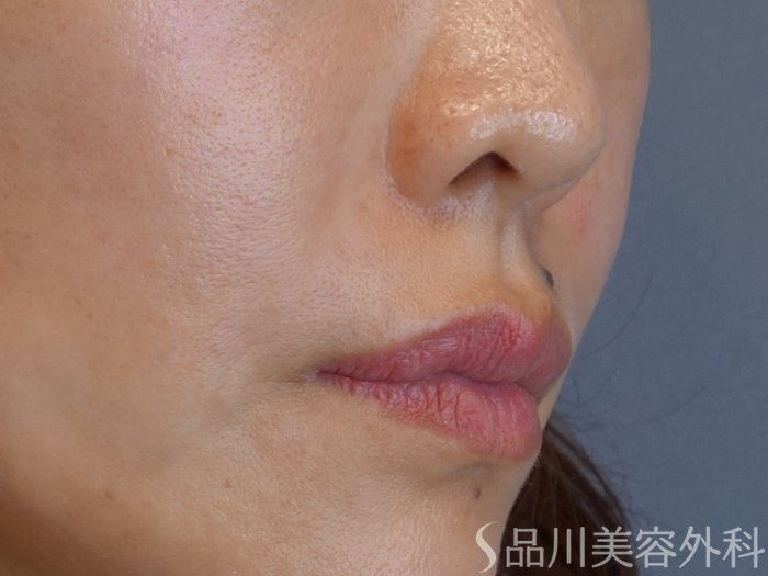 症例NO.72494のAFTER写真