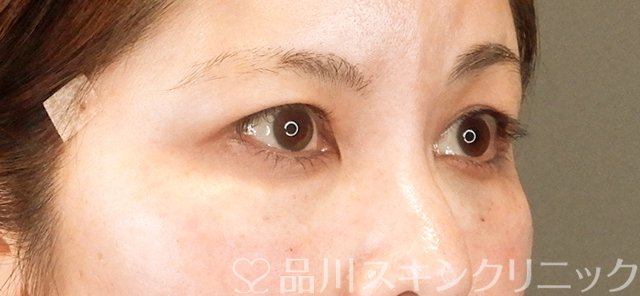症例NO.63340のAFTER写真