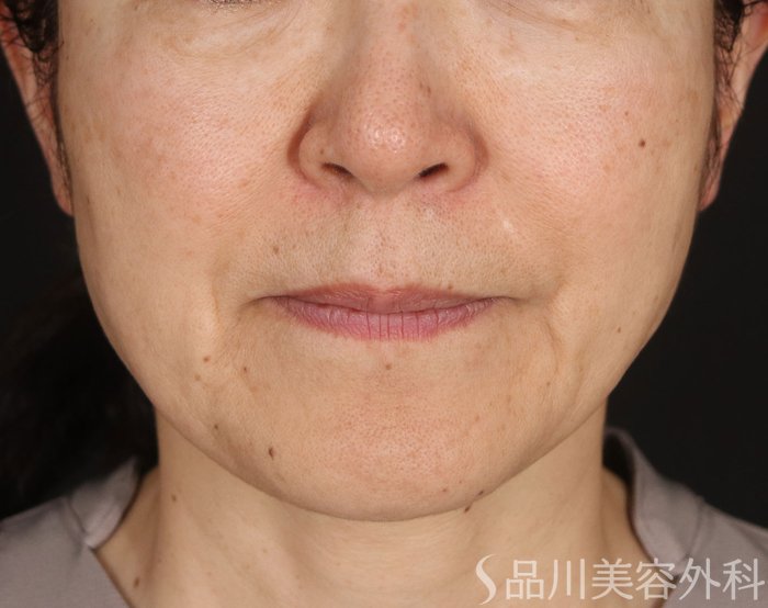 症例NO.73857のBEFORE写真